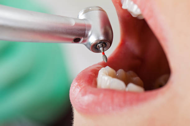 Best Emergency Root Canal Treatment in Ontario, CA